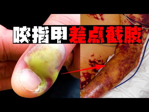 咬手指頭