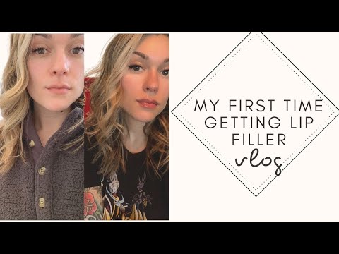 I Got Lip Filler For The First Time!