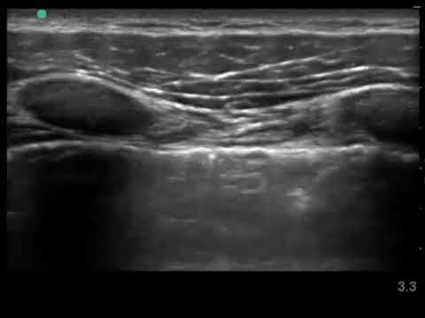 Lung Sliding with Linear Transducer