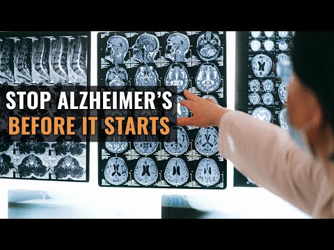 How Do You Stop Alzheimer’s Before It Starts