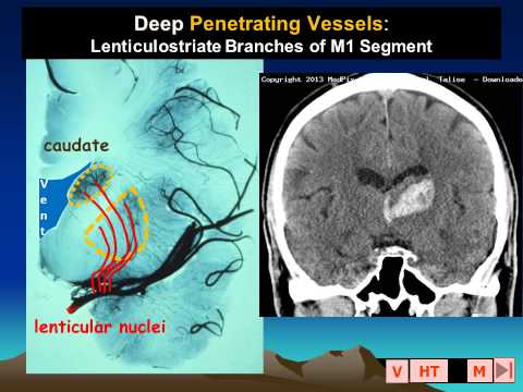 MedPix COW 674 - Hypertensive Hemorrhage
