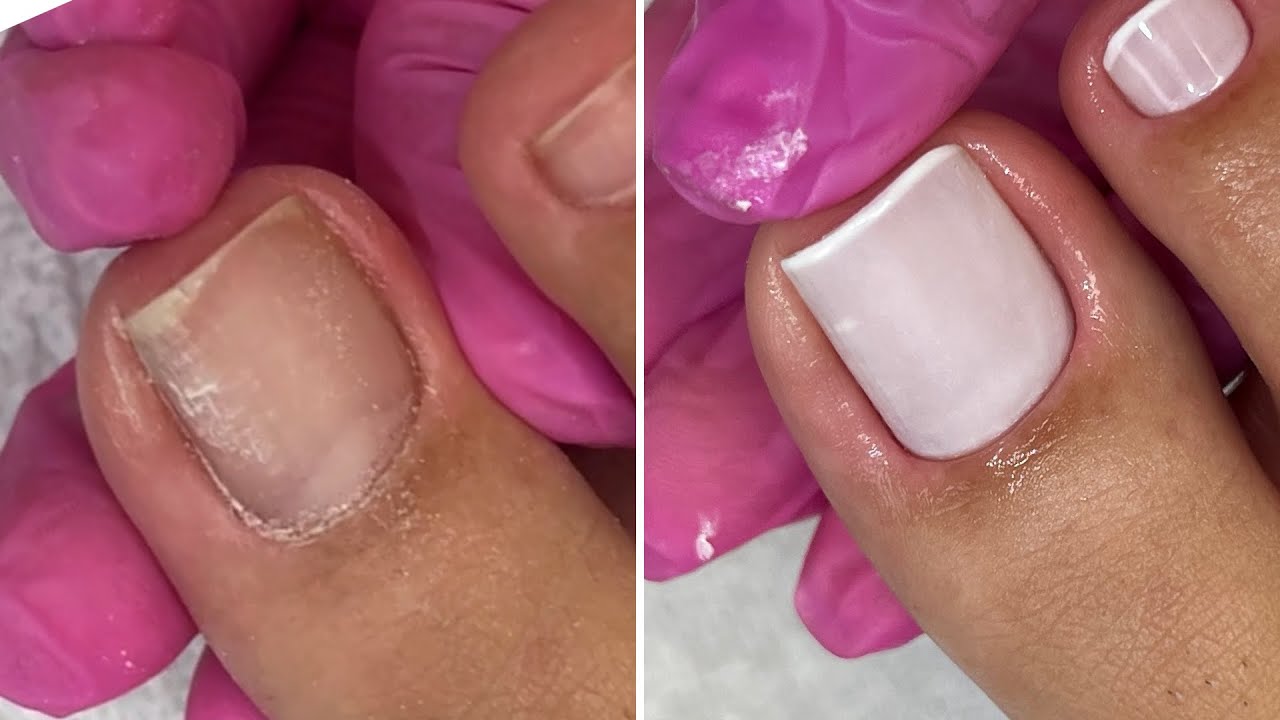 Cutilagem dos pés + Francesinha