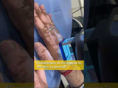 Excimer Laser Vitiligo Treatment in Zirakpur  | The Skin Zeal | Dr. Isha V. Mittal | Call 7293939326