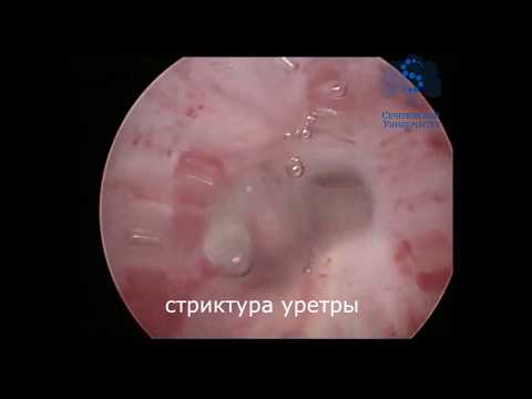 Стриктура уретры. Клинический пример рассечения стриктуры уретры холодным ножом.