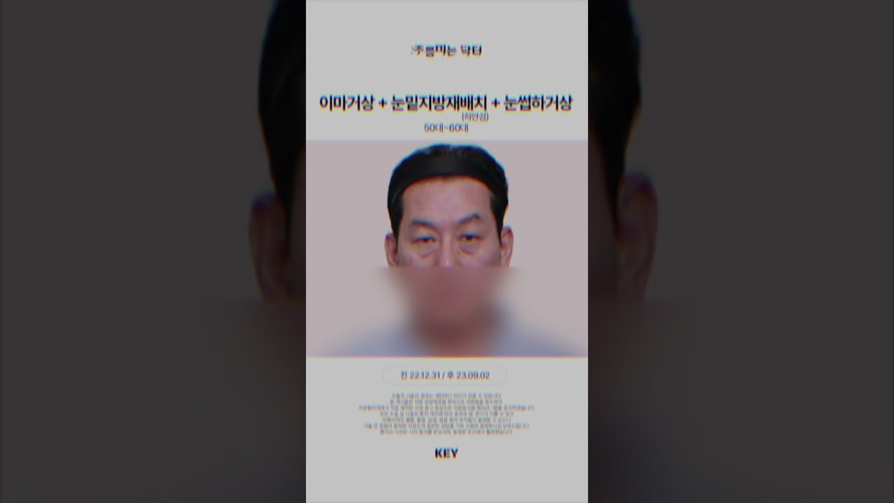 60대 눈밑지방재배치 대구키성형외과