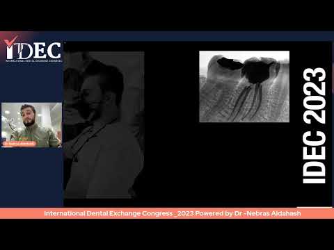 MANAGEMENT OF CALCIFIED & BLOCKED CANALS , Nebras Aldahash 🇱🇾