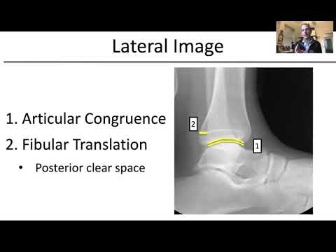 Ankle Fractures - Dr David Shearer