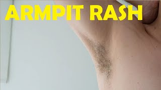 how to get rid of armpit rash from natural deodorant