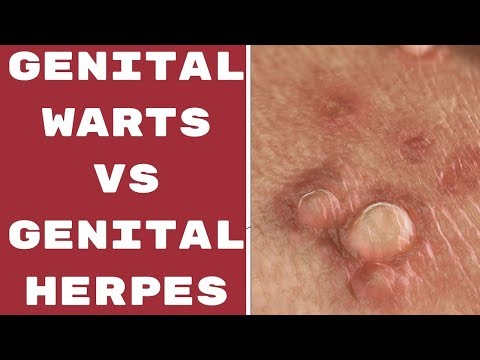 hpv warts and herpes