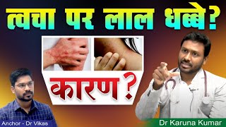 Red Spots over Skin | Causes for Purpura and Excessive bleeding | Dr Karuna Kumar | Hematologist