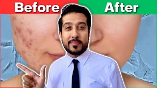 How to Get Rid of EVERY Type of Acne Scar | The Acne Scar ULTIMATE GUIDE