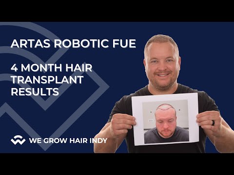 ARTAS Robotic FUE Hair Transplant 4 Months Later - Josh S.