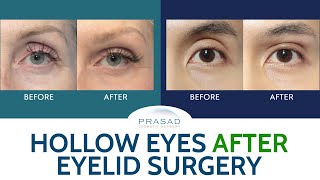 Treating Hollow Upper Eyelids from Previous Surgery