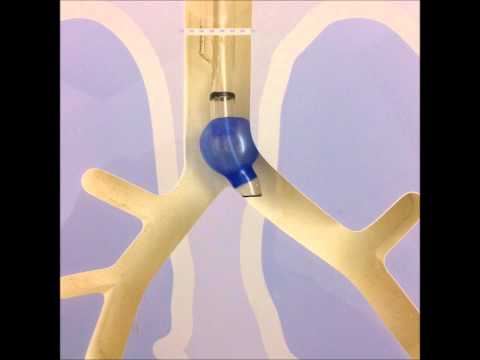 Double lumen endotracheal tubes
