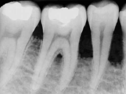 download lagu mp3 mp4 Braces Bone Loss, download lagu Braces Bone Loss gratis, unduh video klip Braces Bone Loss