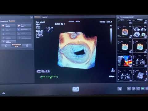 EVALUATION OF MITRAL VALVE AT TRANSESOPHAGEAL ECHOCARDIOGRAPHY (TEE)