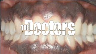 Dr Bill Dorfman Fixing Dark Gums on The Doctors
