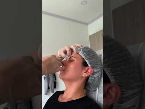 Aplicación Profesional de Botox por la Dermatóloga Laura Habib en Bogotá