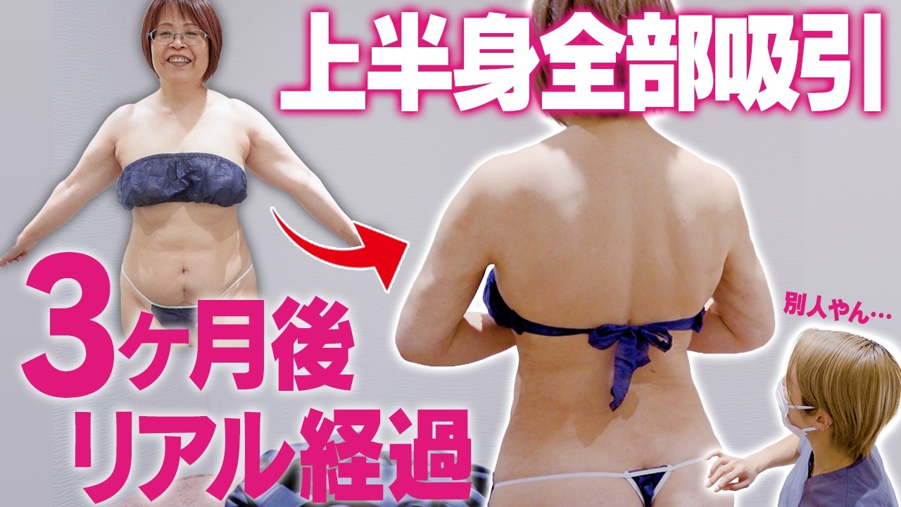 【BMI28】たるみや拘縮は？57歳上半身全部吸引から3ヶ月のリアル経過を公開。｜脂肪吸引の母#266