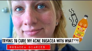 A Natural Treatment For Acne Rosacea??! | Rosacea Diaries | Trying Apple Cider Vinegar Part 1