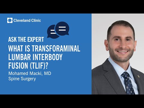 What Is Transforaminal Lumbar Interbody Fusion (TLIF)? | Ask Cleveland Clinic's Expert