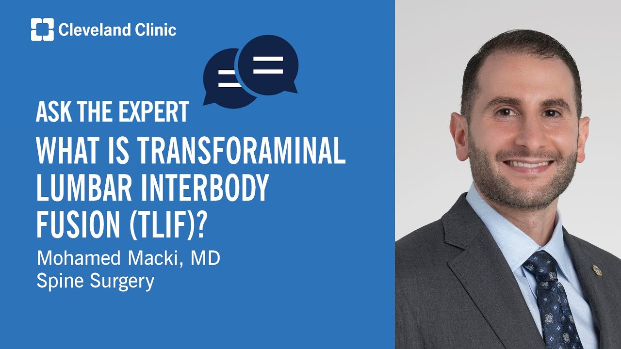 What Is Transforaminal Lumbar Interbody Fusion (TLIF)? | Ask Cleveland Clinic's Expert