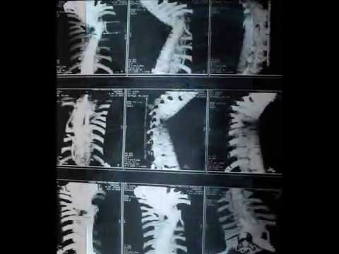 Vertebral Column Deformation and Neurofibromatosis