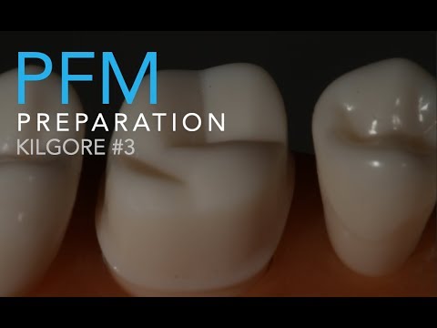 Molar Ceramo-Metal Preparation | How to Prepare a PFM On a Maxillary Molar