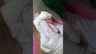 Ep_8839 Big ingrown toenail removal 👣 ออกแล้วรึครับ 😅 (clip from Thailand)