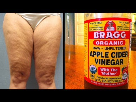 Ako ay 14 taong gulang paano alisin ang tiyan at hips sa bahay Kung paano alisin cellulite mula sa mga binti 3 linggo