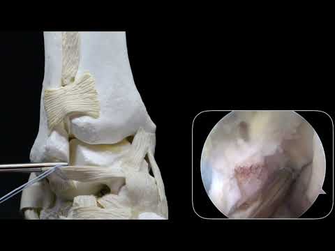 Vídeo: reparación del ligamento lateral del tobillo con anclajes, técnica de Arthrex