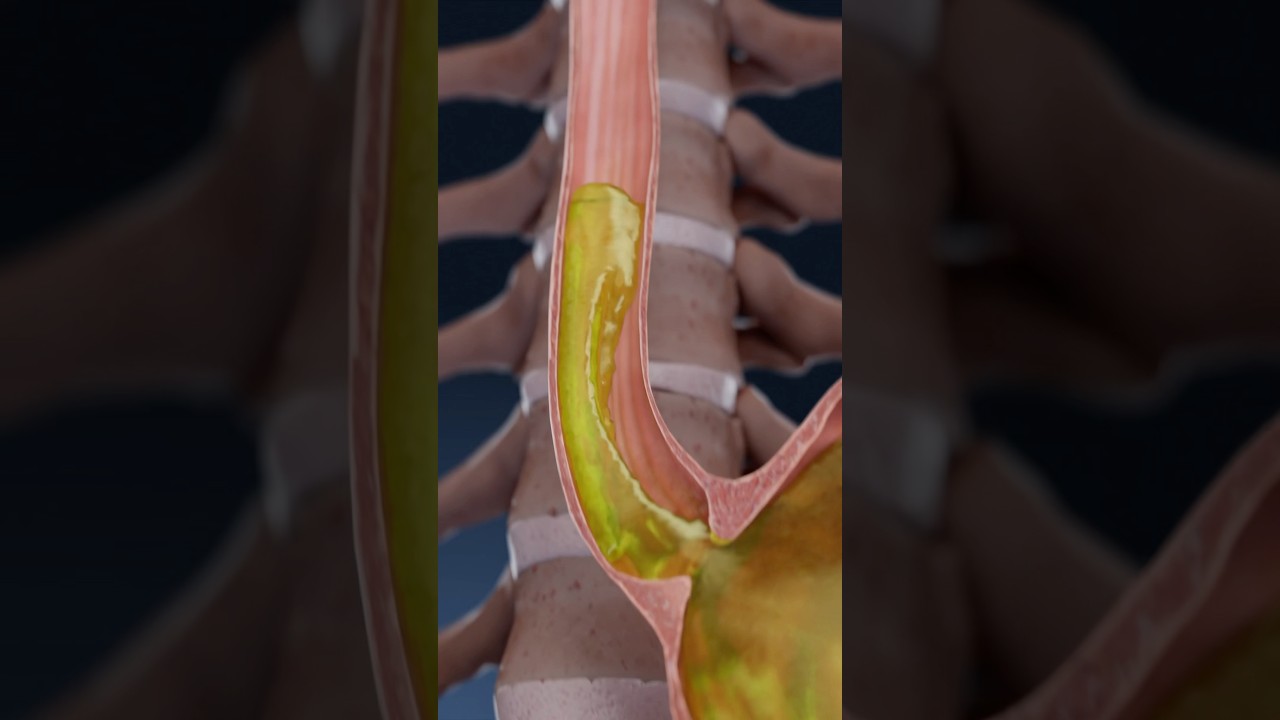 Acid Reflux, GERD, and Heartburn explained in 3D