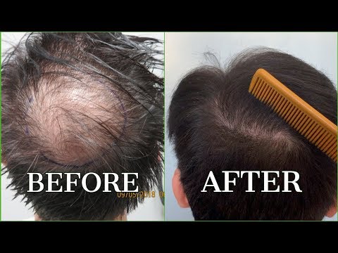Hair Transplant for CROWN area - BEFORE & AFTER - Dr.
