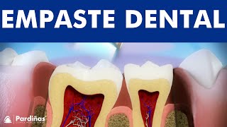 Tratamiento caries - Restauración con composite © - Clínica Dental Pardiñas