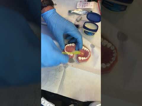 Glass ionomer dental sealant - MacIntyre finger technique (Riva)