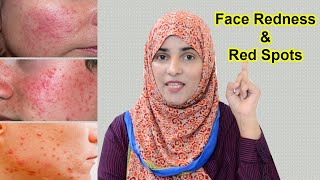 6 Remedies for Red Spots, Face Redness & Red Bumps -- 30 Days Skincare Guide (Day 26)