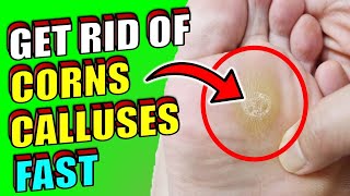 HOW TO GET RID OF CORNS & CALLUSES ON FEET | FAST & EFFECTIVE HOME REMEDIES