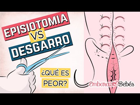 ✂️😰 EPISIOTOMÍA vs DESGARRO ¿Qué es PEOR? | El parto