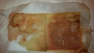 Hidradenitis Suppurativa leakage #2