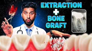 Tooth Extraction and Bone Graft for Dental Implants (Tools, Sectioning, Flap, Suturing)