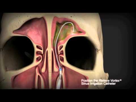 Balloon Sinuplasty - Willis Knighton Health