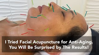 I Had Facial Acupuncture For The First Time. I Was Surprised What It Told Me About My Health!