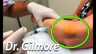 Attack of the Tennis Elbow!  Dr. Gilmore Treatment
