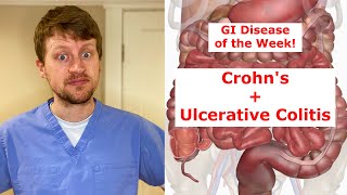 Inflammatory Bowel Disease (Crohn’s and Ulcerative Colitis) in 90 Seconds