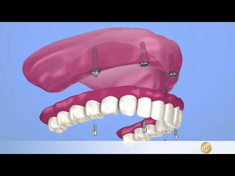 Implantologie: Fester Zahnersatz mit All-On-4-Implantat im Oberkiefer