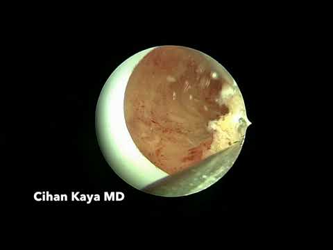 Hysteroscopic Septum