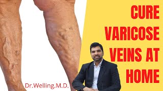 Permanent Cure of Varicose Veins Without Surgery • Homeopathy Treatment of Varicose Veins