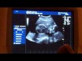 It S Definitely A Boy