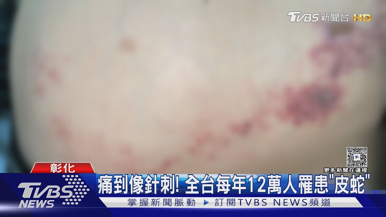「皮蛇」靠近眼睛恐致失明!全台疫苗補助懶人包 彰化最狂「省破萬元」