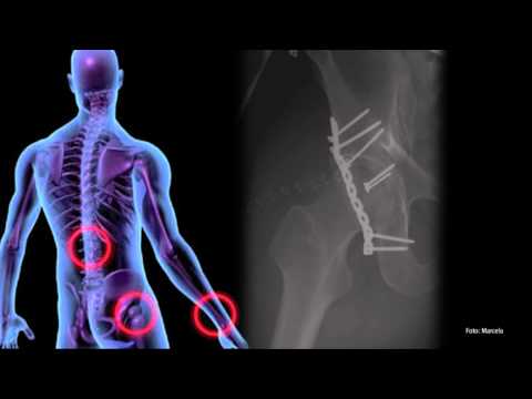 Osteochondrose eines Arztes kann helfen Korsetts für die Rückseite der Brustwirbelsäule Hernie kaufen
